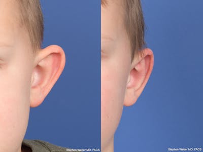 Otoplasty Before & After Gallery - Patient 191318 - Image 1