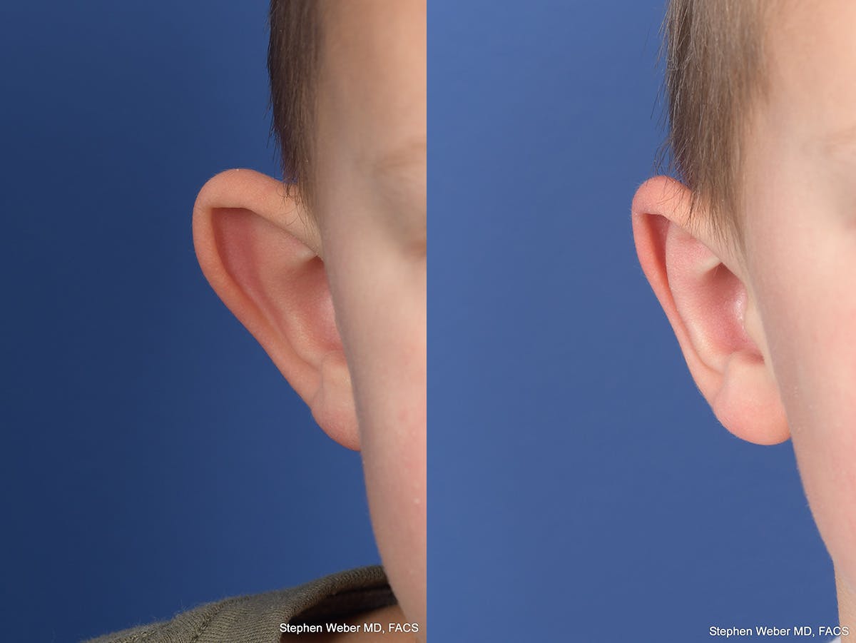 Otoplasty Before & After Gallery - Patient 191318 - Image 2