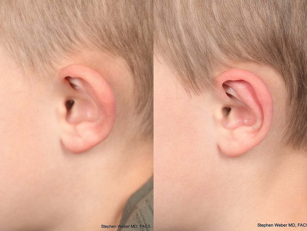 Otoplasty Before & After Gallery - Patient 191318 - Image 6