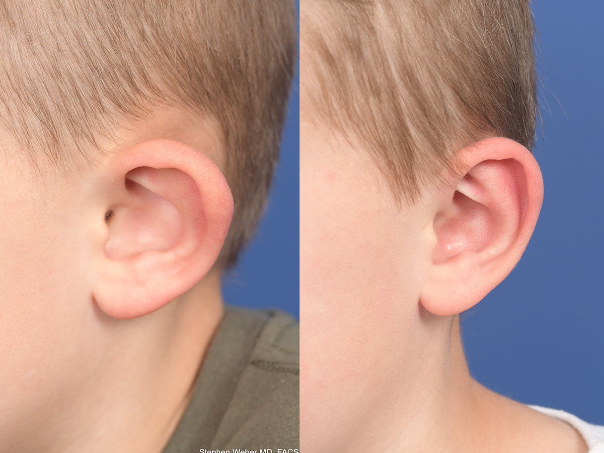 Otoplasty Before & After Gallery - Patient 191318 - Image 4