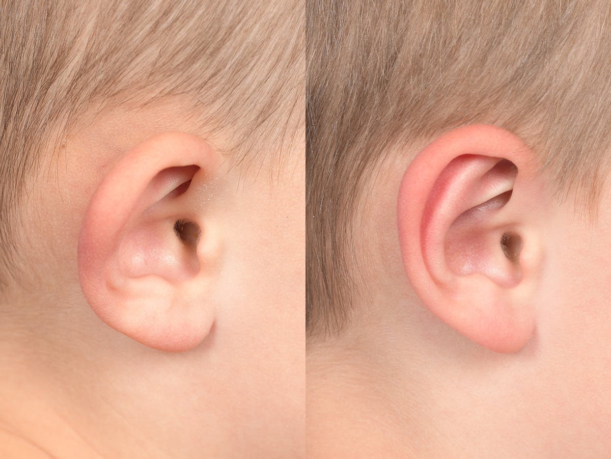 Otoplasty Before & After Gallery - Patient 191318 - Image 5