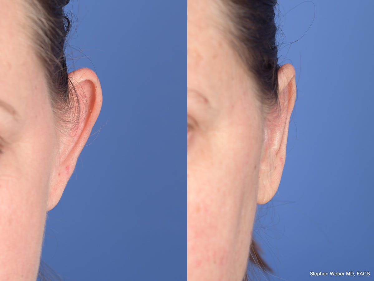 Otoplasty Before & After Gallery - Patient 720871 - Image 1