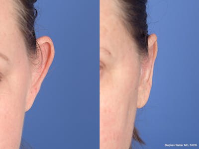 Otoplasty Before & After Gallery - Patient 720871 - Image 1