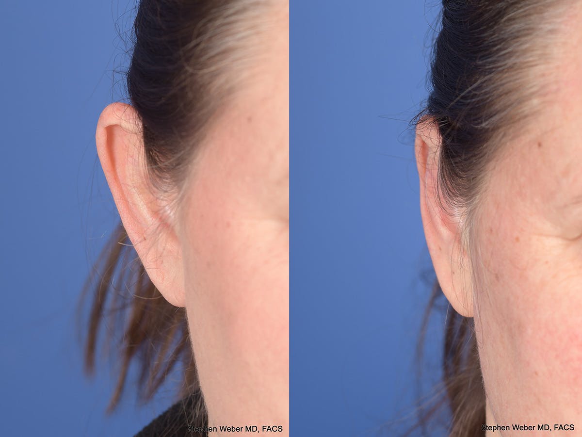 Otoplasty Before & After Gallery - Patient 720871 - Image 2