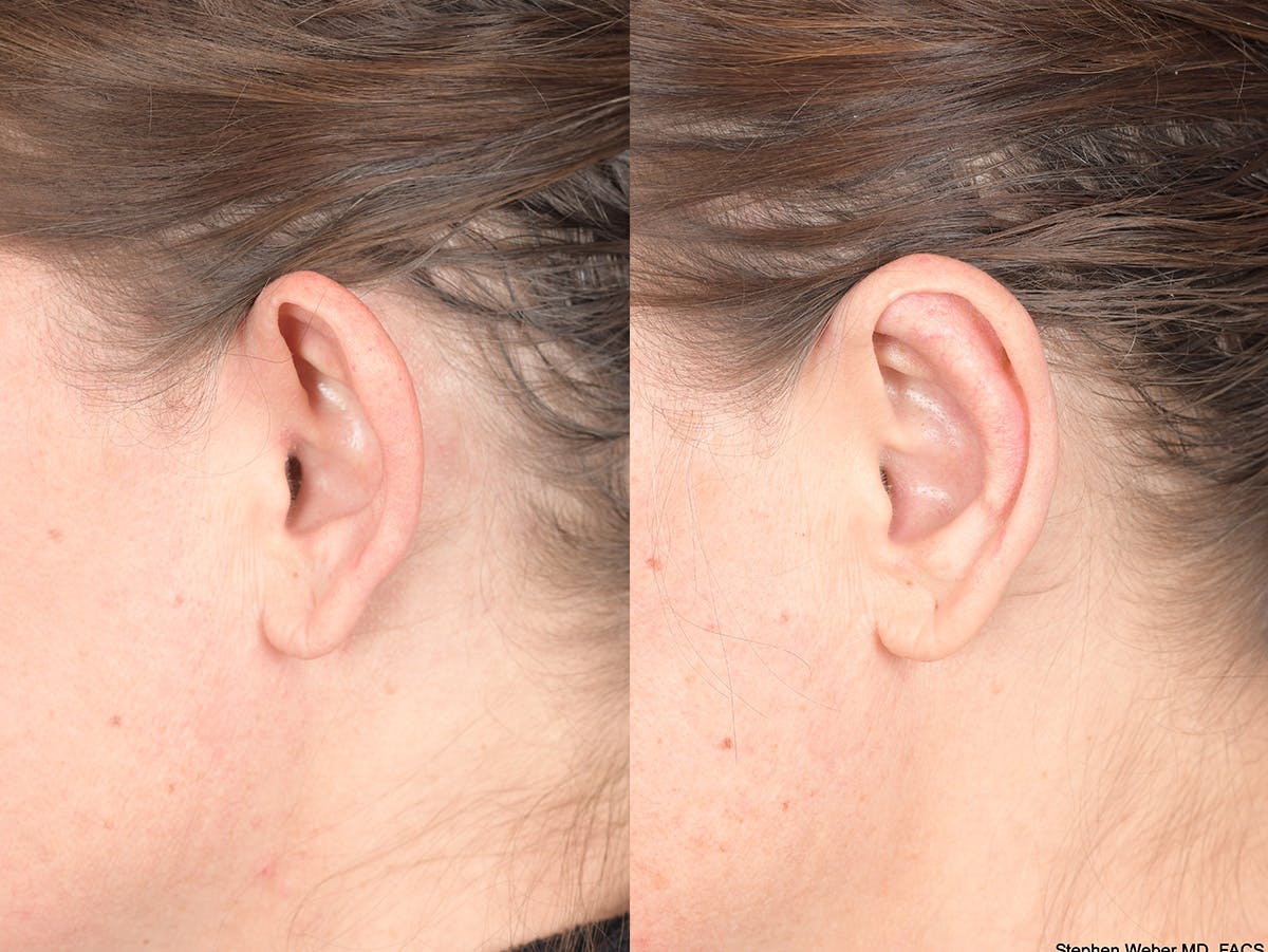 Otoplasty Before & After Gallery - Patient 720871 - Image 6