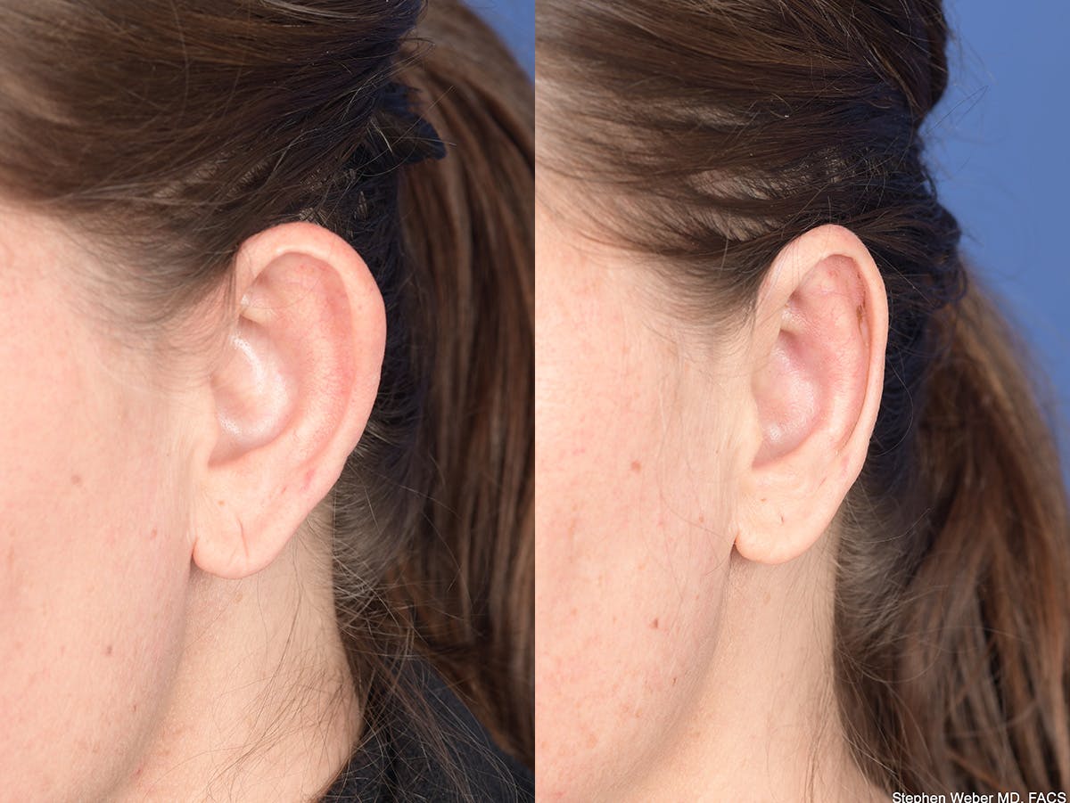 Otoplasty Before & After Gallery - Patient 720871 - Image 4