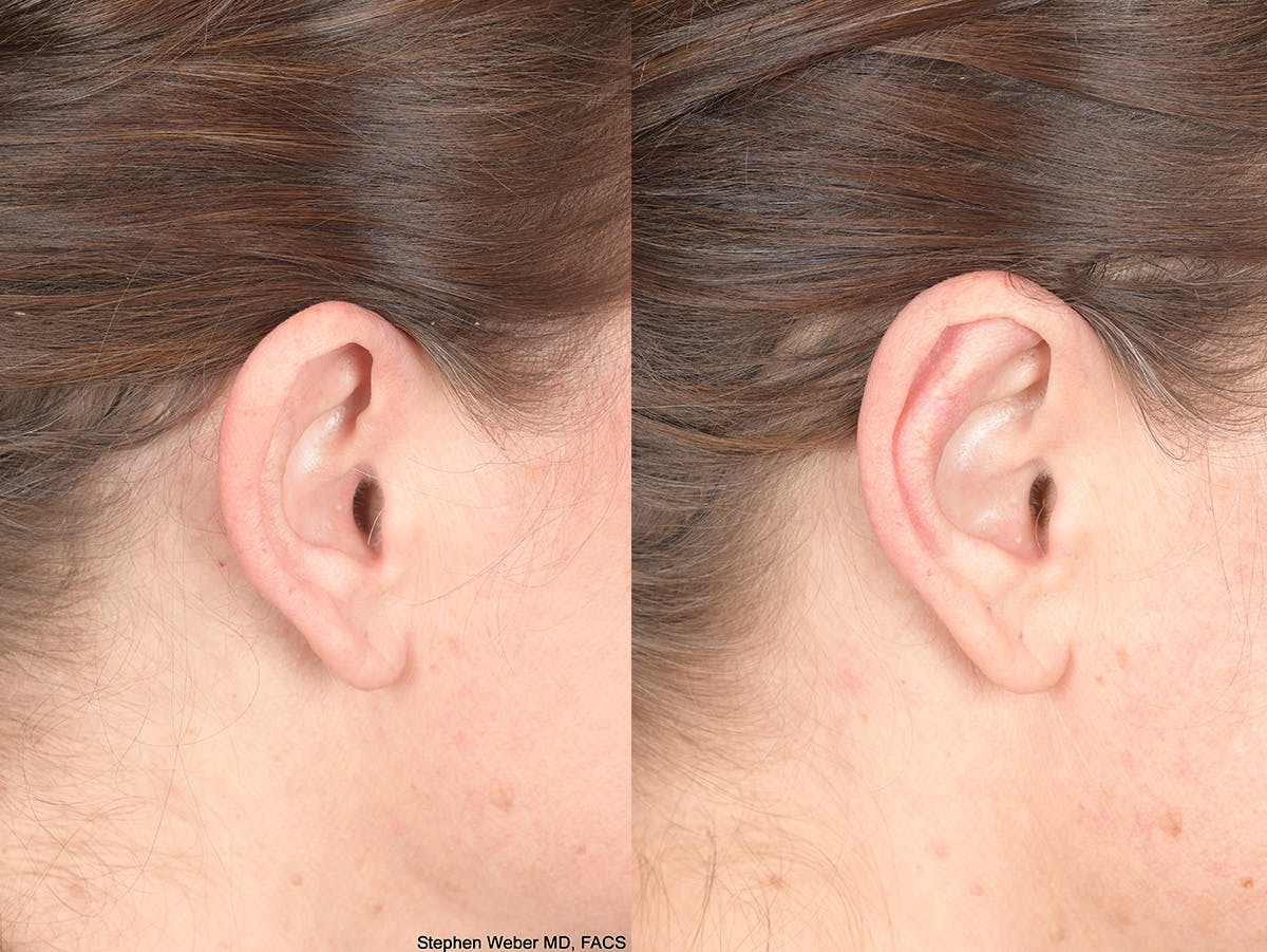Otoplasty Before & After Gallery - Patient 720871 - Image 5