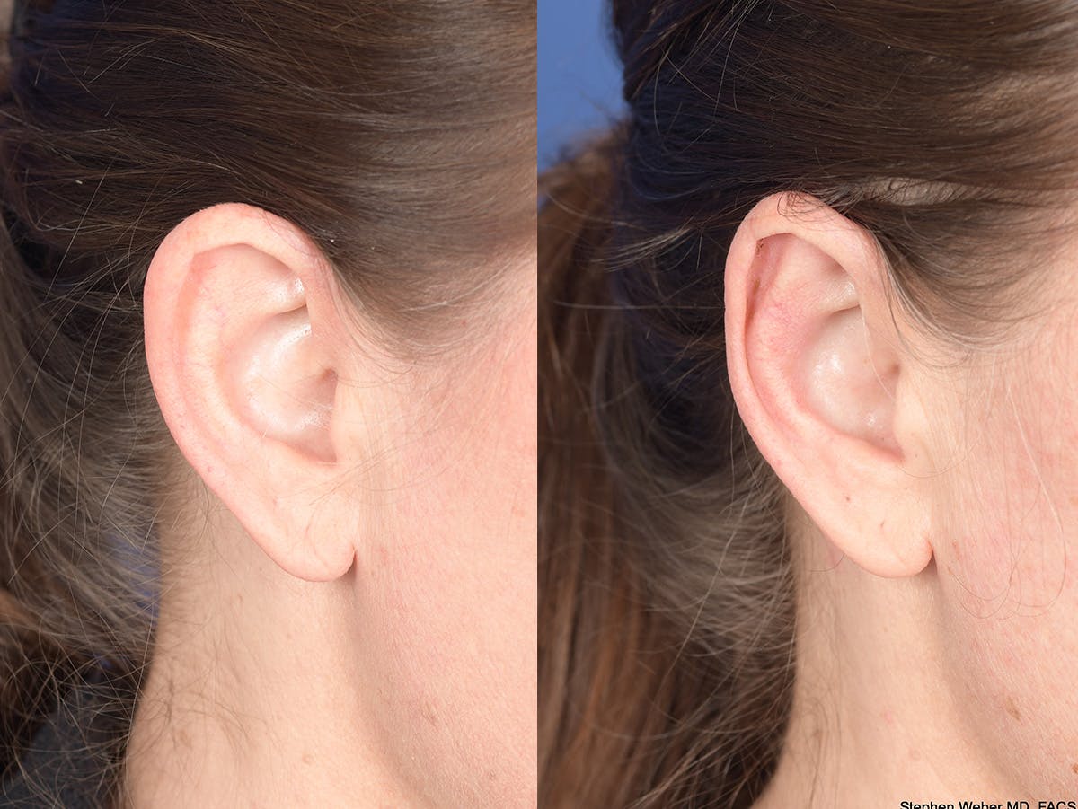 Otoplasty Before & After Gallery - Patient 720871 - Image 3