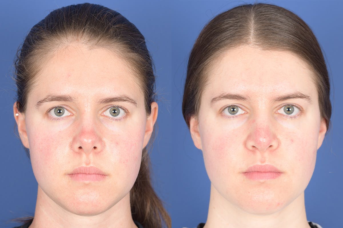 Revision Rhinoplasty Before & After Gallery - Patient 291117 - Image 1