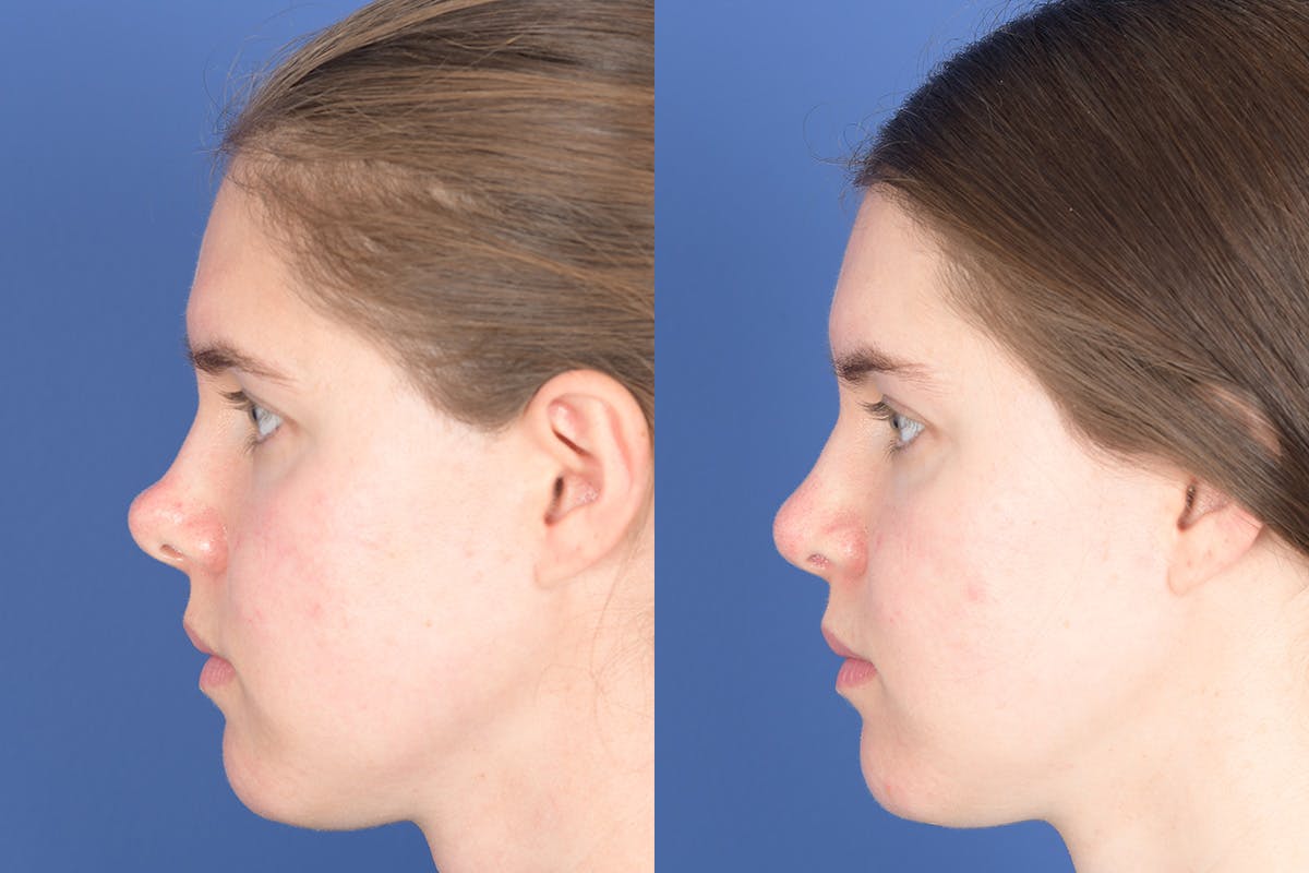 Revision Rhinoplasty Before & After Gallery - Patient 291117 - Image 5