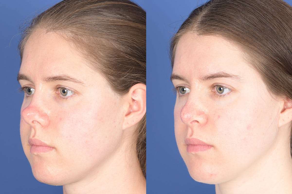 Revision Rhinoplasty Before & After Gallery - Patient 291117 - Image 4
