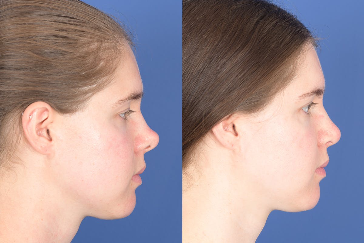 Revision Rhinoplasty Before & After Gallery - Patient 291117 - Image 3
