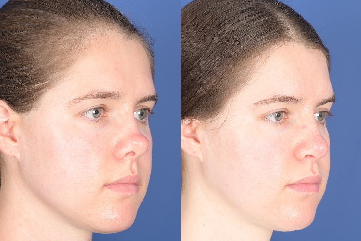 Revision Rhinoplasty Before & After Gallery - Patient 291117 - Image 2