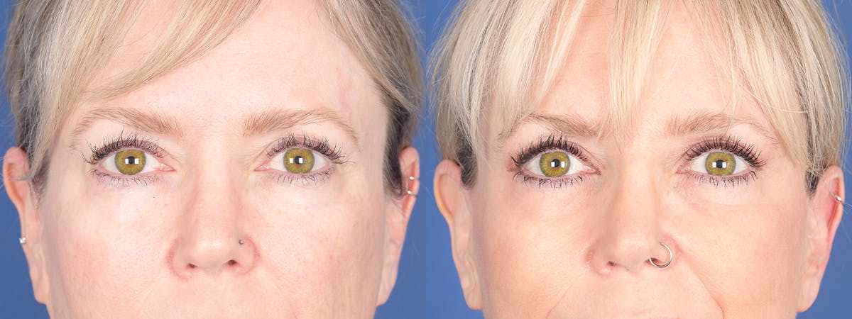 Blepharoplasty Before & After Gallery - Patient 397566 - Image 1