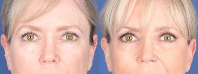 Blepharoplasty Before & After Gallery - Patient 397566 - Image 1