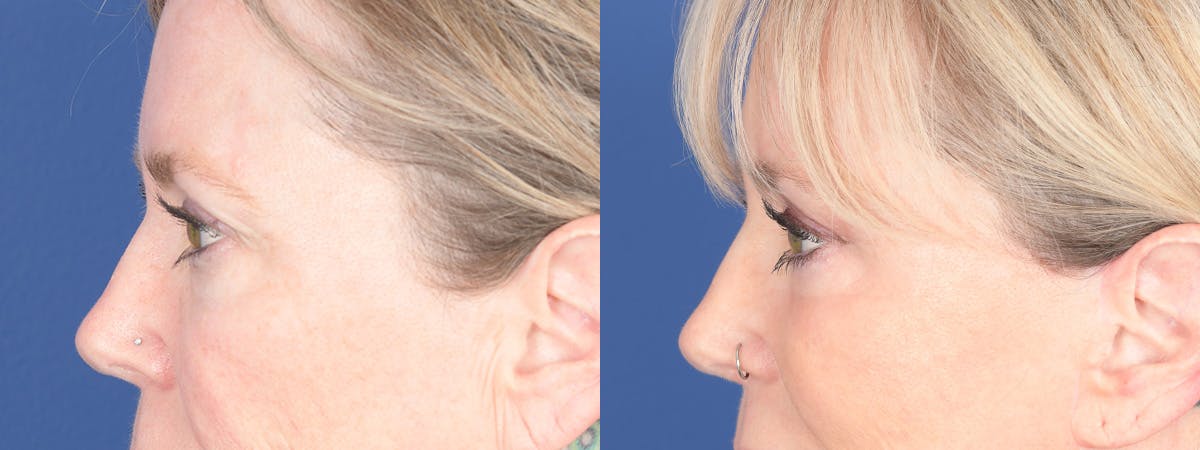 Blepharoplasty Before & After Gallery - Patient 397566 - Image 5