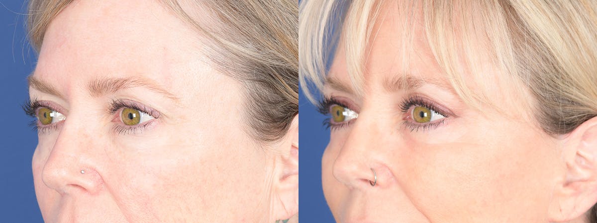 Blepharoplasty Before & After Gallery - Patient 397566 - Image 4