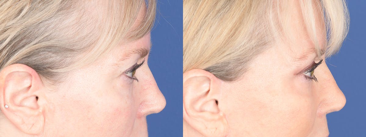 Blepharoplasty Before & After Gallery - Patient 397566 - Image 3