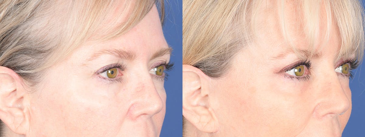Blepharoplasty Before & After Gallery - Patient 397566 - Image 2