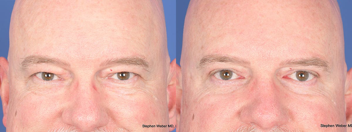 Blepharoplasty Before & After Gallery - Patient 103080 - Image 1