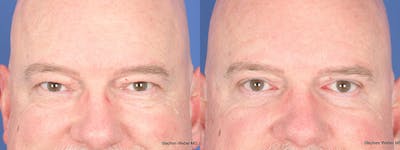 Blepharoplasty Before & After Gallery - Patient 103080 - Image 1