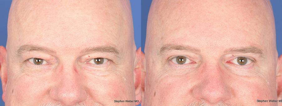 Eyelid Surgery Before and After Photos