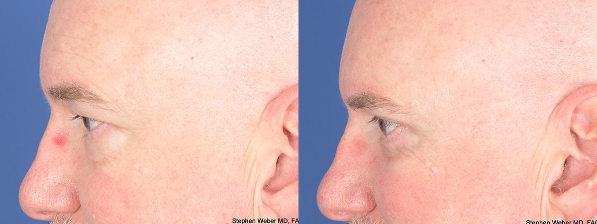 Blepharoplasty Before & After Gallery - Patient 103080 - Image 5