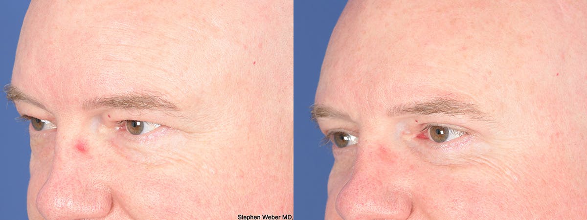 Blepharoplasty Before & After Gallery - Patient 103080 - Image 4