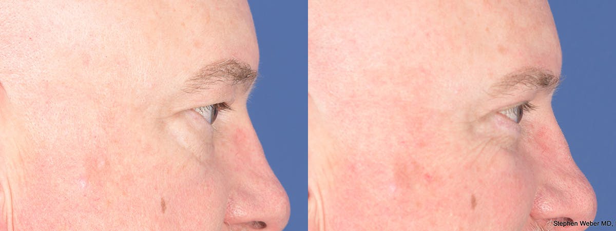 Blepharoplasty Before & After Gallery - Patient 103080 - Image 3