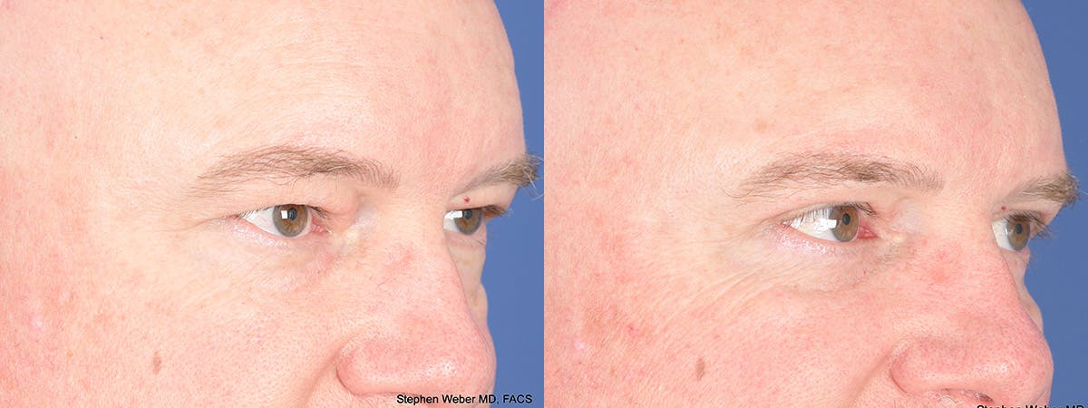 Blepharoplasty Before & After Gallery - Patient 103080 - Image 2