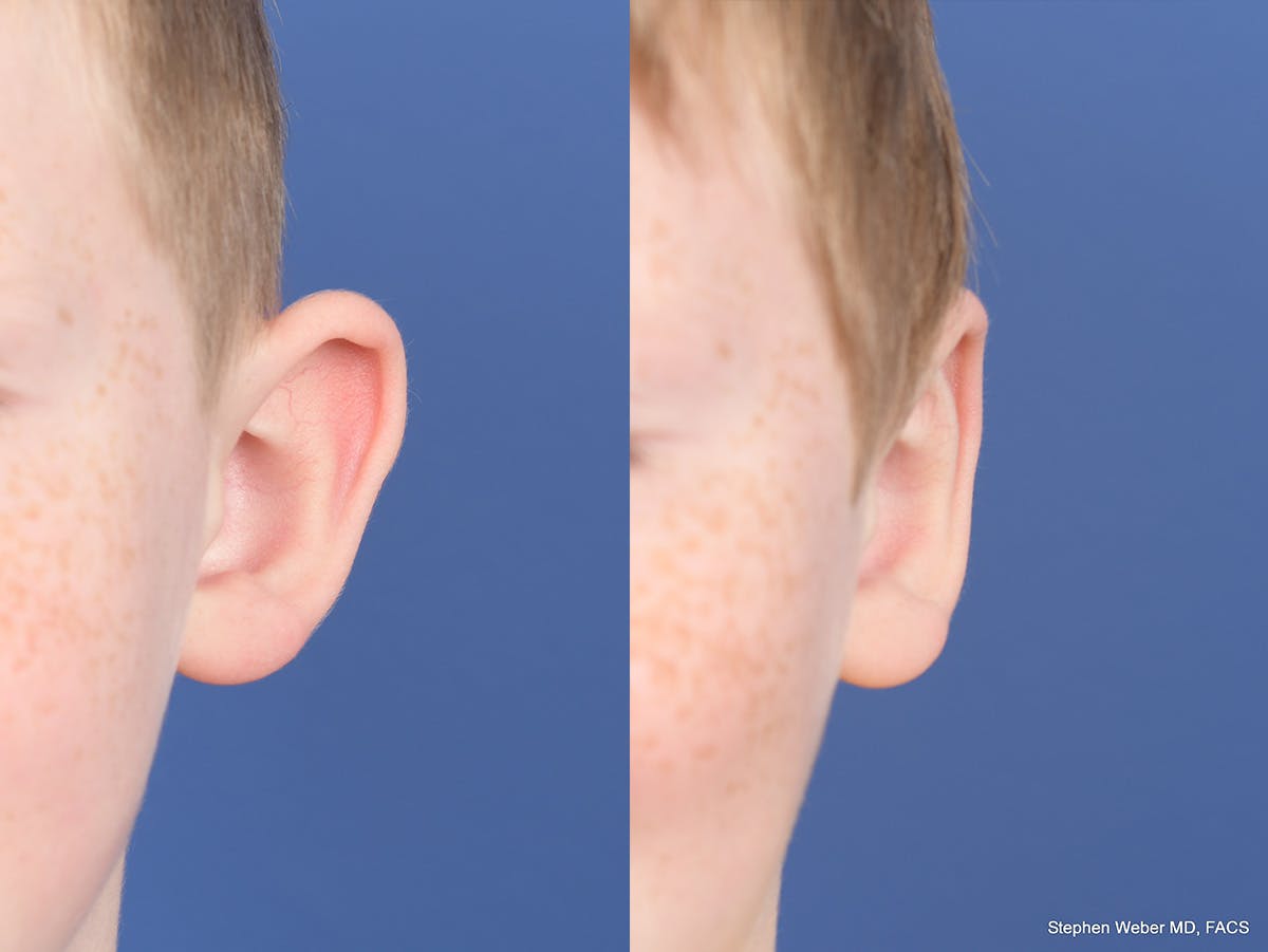 Otoplasty Before & After Gallery - Patient 198923 - Image 1