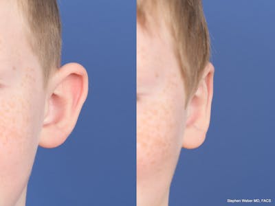 Otoplasty Before & After Gallery - Patient 198923 - Image 1