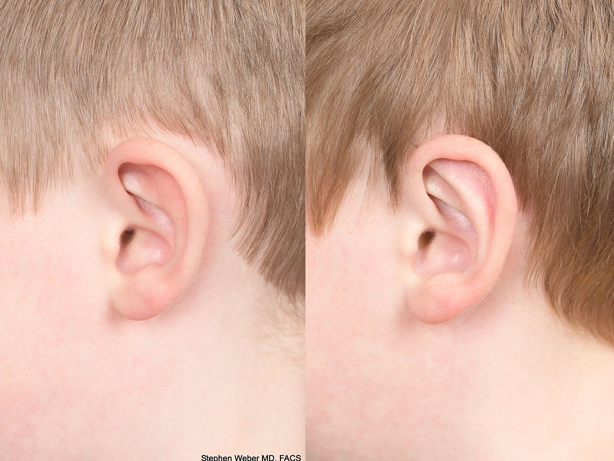 Otoplasty Before & After Gallery - Patient 198923 - Image 6