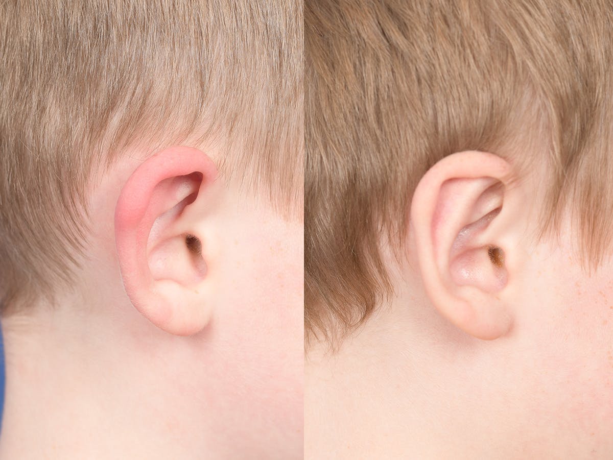 Otoplasty Before & After Gallery - Patient 198923 - Image 5