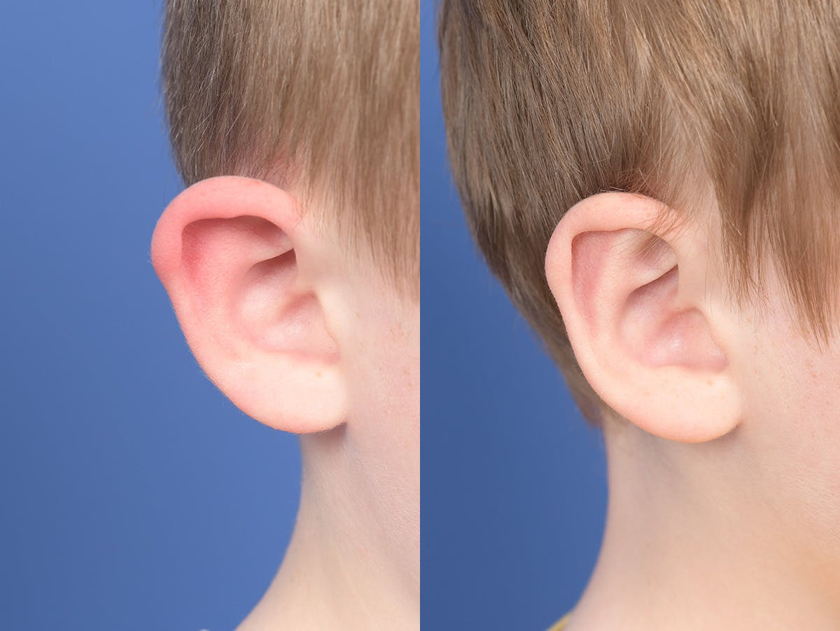 Otoplasty Before & After Gallery - Patient 198923 - Image 3