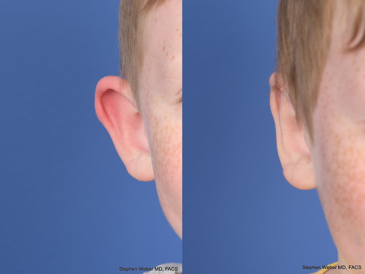 Otoplasty Before & After Gallery - Patient 198923 - Image 2