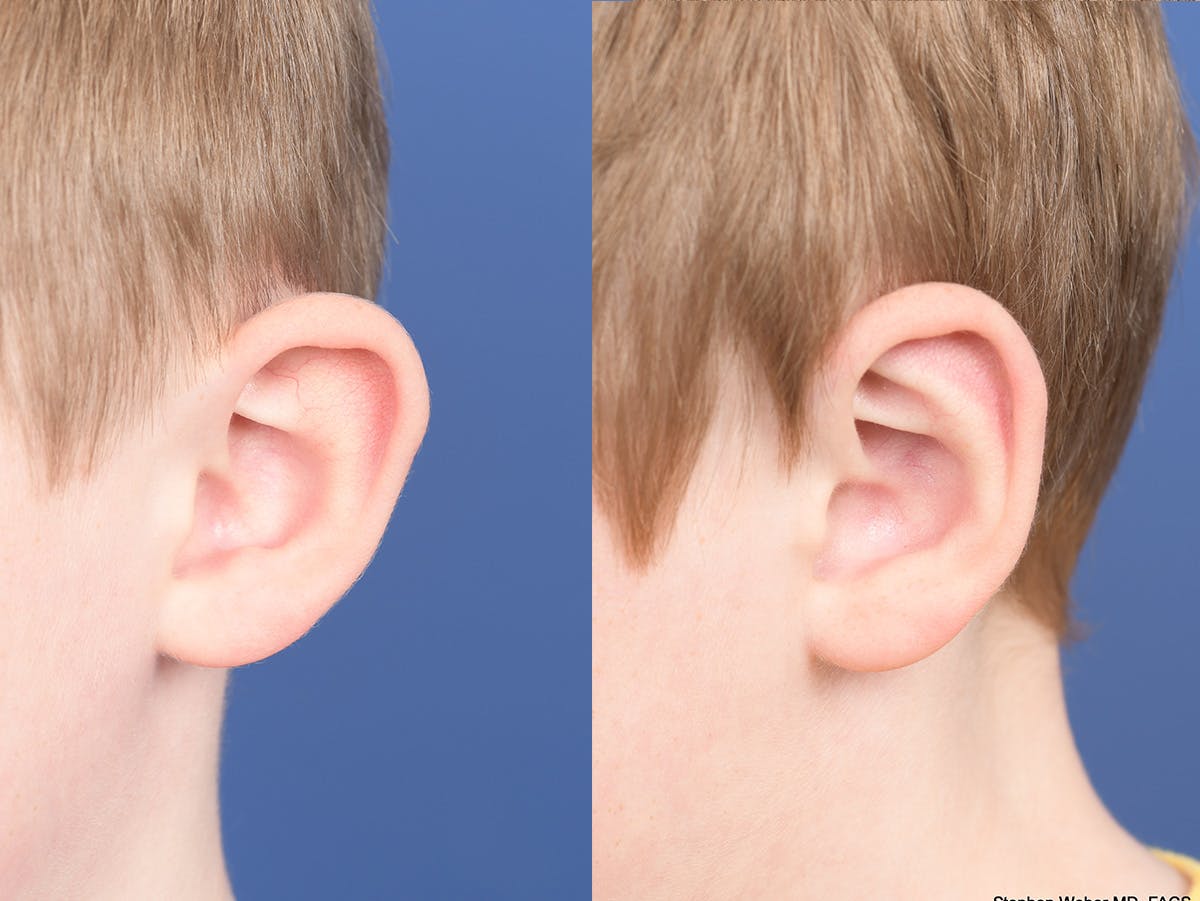 Otoplasty Before & After Gallery - Patient 198923 - Image 4