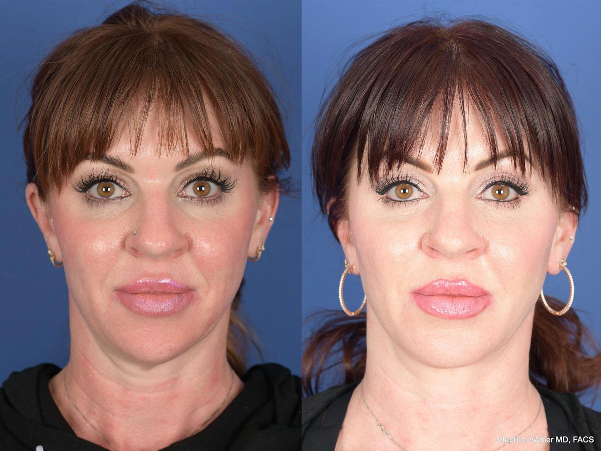 Necklift Before & After Gallery - Patient 218495 - Image 1