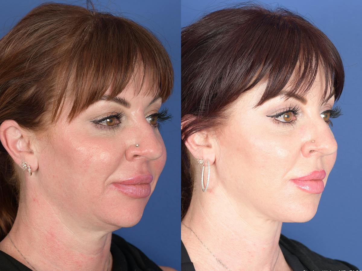 Necklift Before & After Gallery - Patient 218495 - Image 2