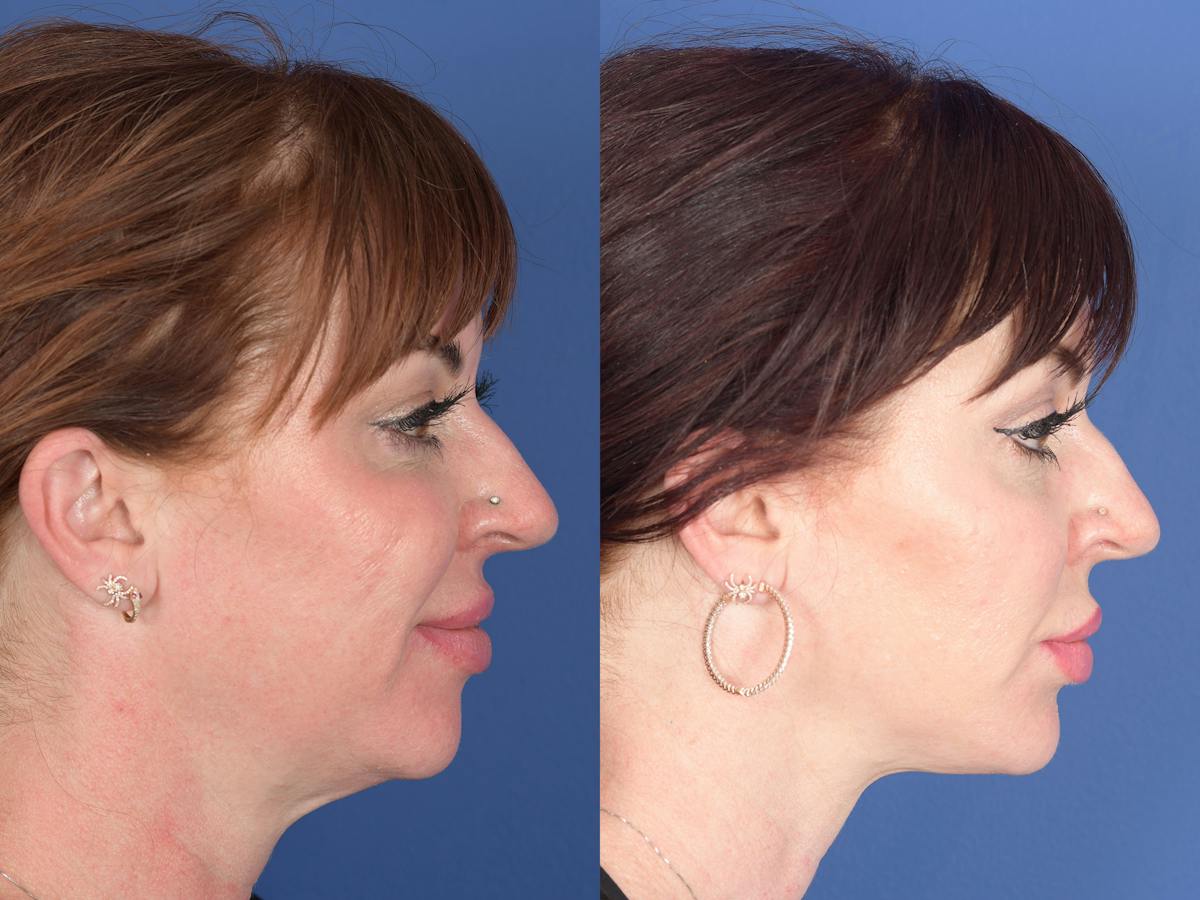 Necklift Before & After Gallery - Patient 218495 - Image 3