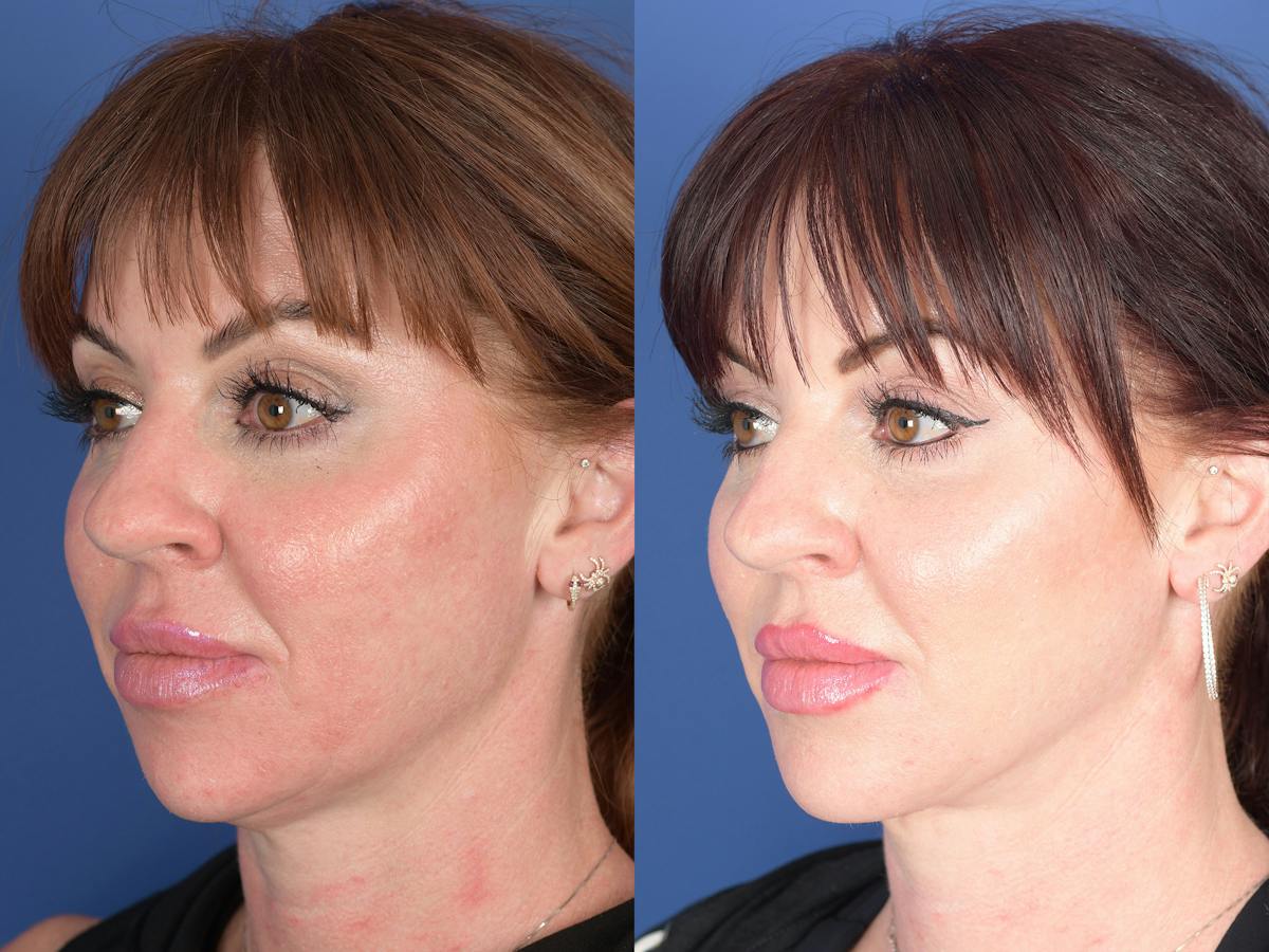 Necklift Before & After Gallery - Patient 218495 - Image 4