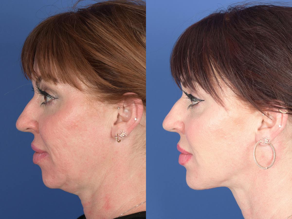 Necklift Before & After Gallery - Patient 218495 - Image 5