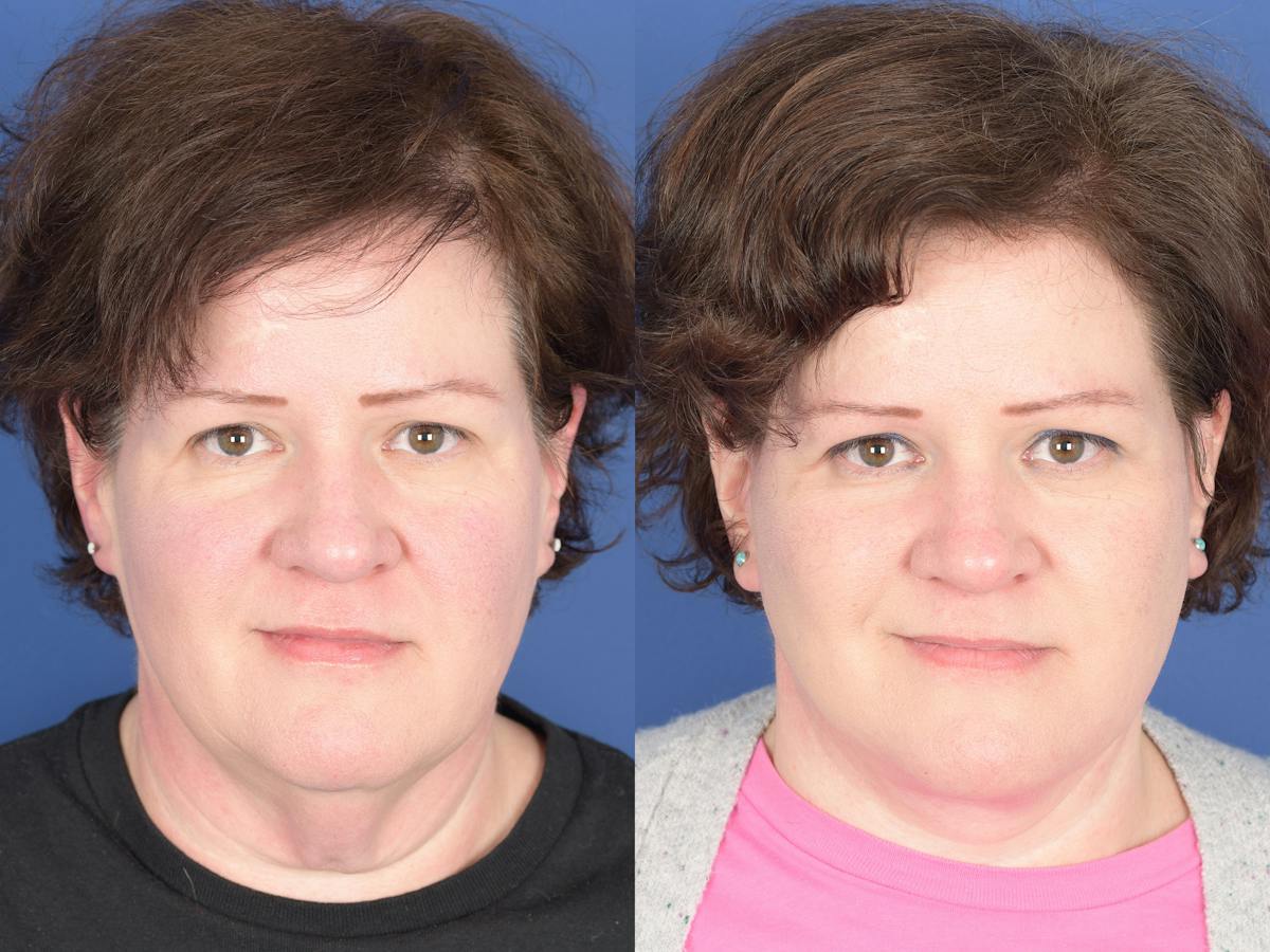 Facelift Before & After Gallery - Patient 358388 - Image 1