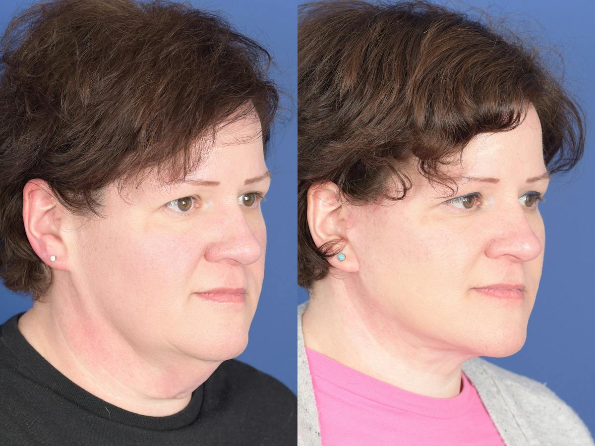 Facelift Before & After Gallery - Patient 358388 - Image 2