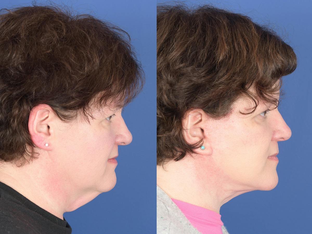 Facelift Before & After Gallery - Patient 358388 - Image 3