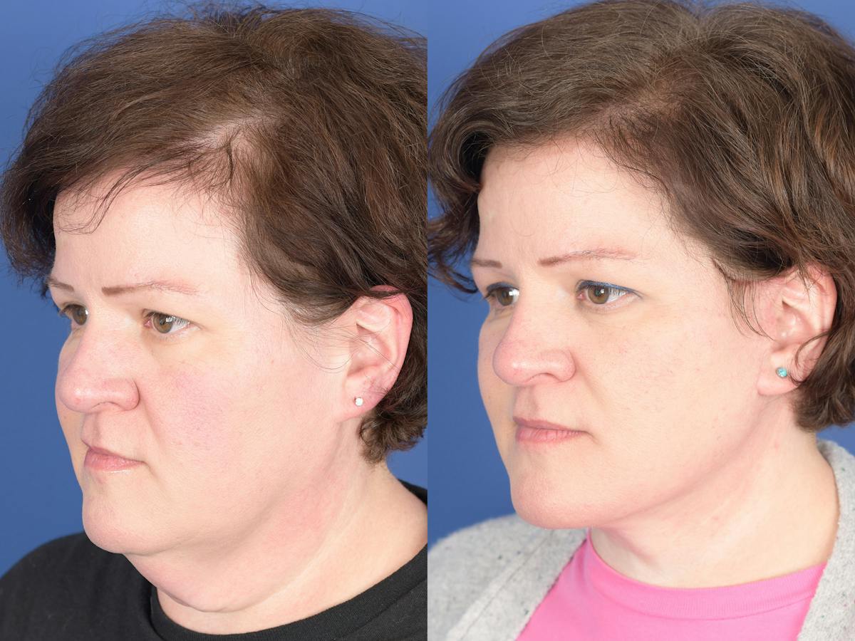 Facelift Before & After Gallery - Patient 358388 - Image 4