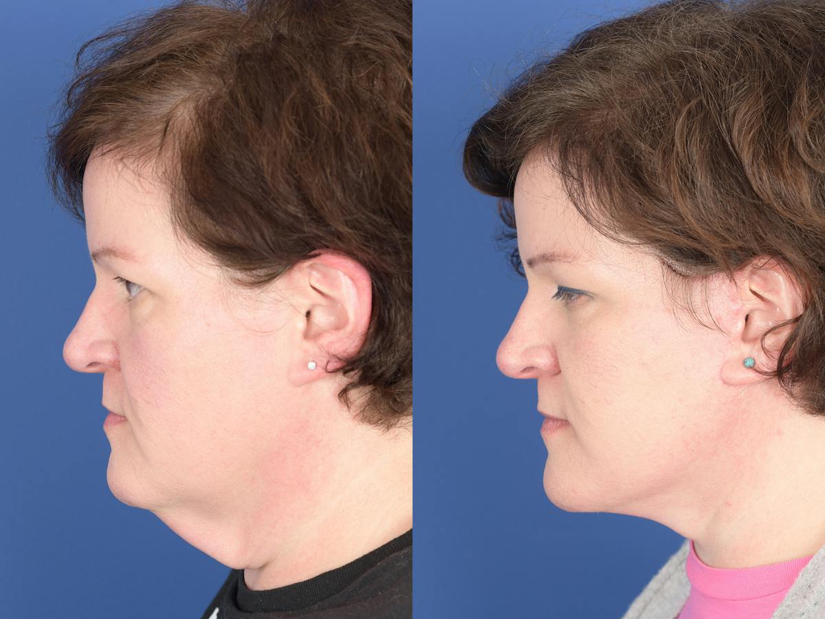 Facelift Before & After Gallery - Patient 358388 - Image 5