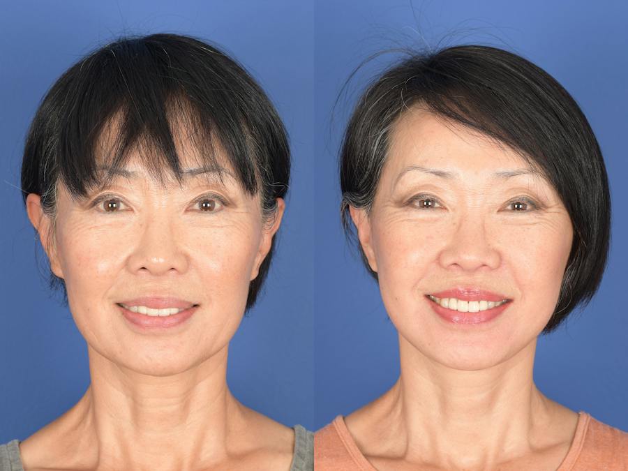Why Our Photo Gallery Is Better Before and After Photos