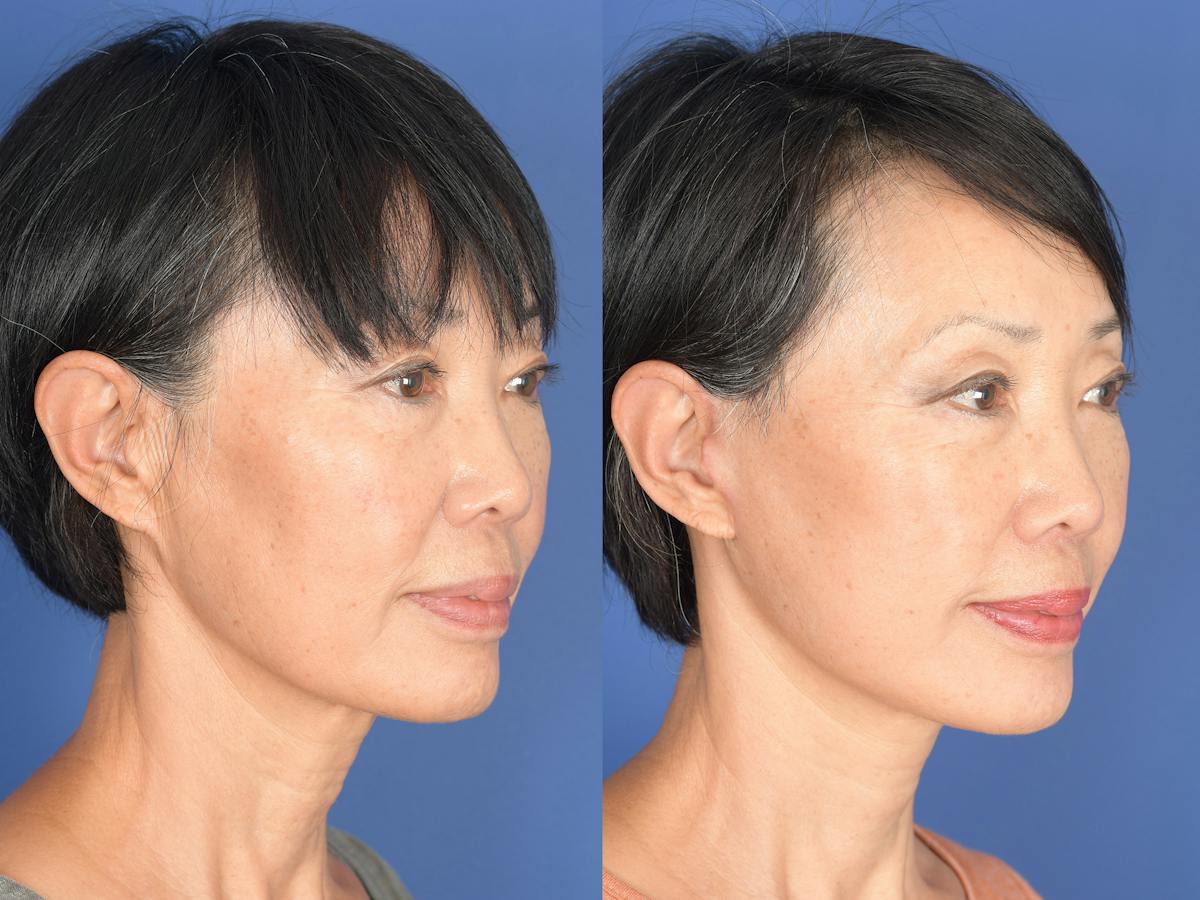 Facelift Before & After Gallery - Patient 198653 - Image 2