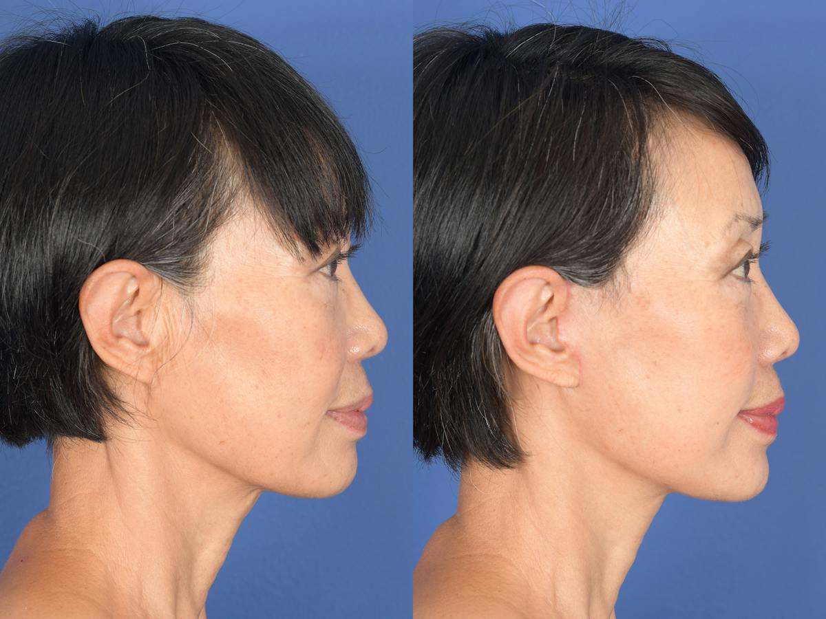 Facelift Before & After Gallery - Patient 198653 - Image 3